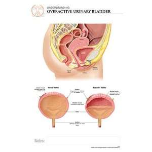    It Disease Chart OVERACTIVE URINARY BLADDER FEMALE 